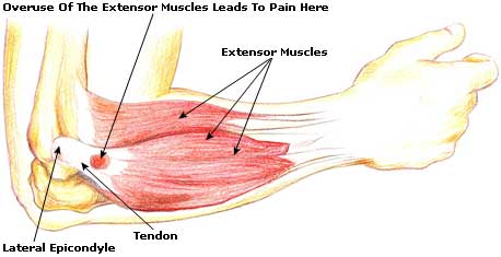 Athletic Injuries 101: Tennis Elbow – Chatham-Kent Sports Network